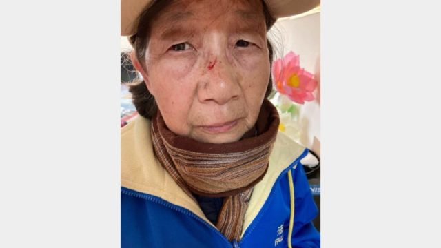 Lü Anmin, una donna di 73 anni, ha riportato lesioni al volto a seguito di un'aggressione avvenuta il 25 marzo 2026 a Flushing, New York. (Global Tuidang Center)